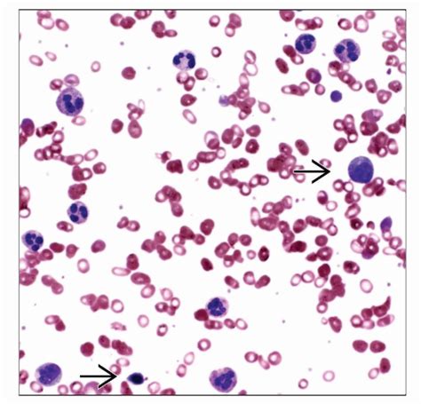 Primary Myelofibrosis | Basicmedical Key