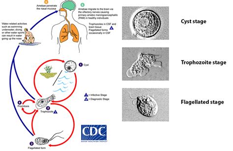 Primary amebic meningoencephalitis causes, symptoms, diagnosis & treatment