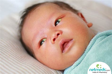 Newborn Jaundice: Causes, Symptoms And Treatment | Netmeds