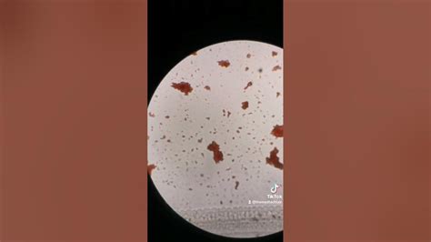 Blood agglutination under the microscope #blood #bloodcells #medtech # ...