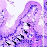 (A) Foveolar hyperplasia (between arrows); in comparison to normal... | Download Scientific Diagram