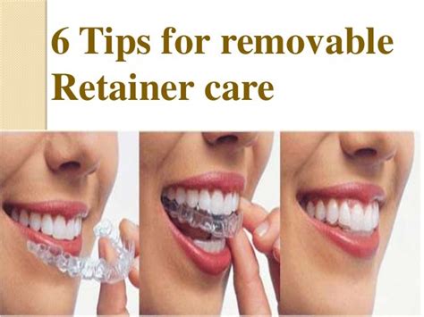 Six tips for Removable retainer care