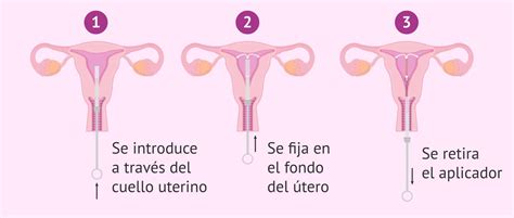 Cómo Funciona La T De Cobre – MiBBmemima ️