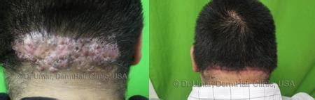 removal of Acne Keloidalis Nuchae - FineTouch Dermatology