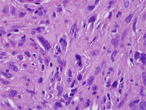 An unusual presentation of atypical fibroxanthoma