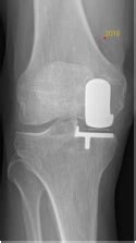 Hemi-knee Replacement - Burn Orthopaedics - BURN ORTHOPAEDICS