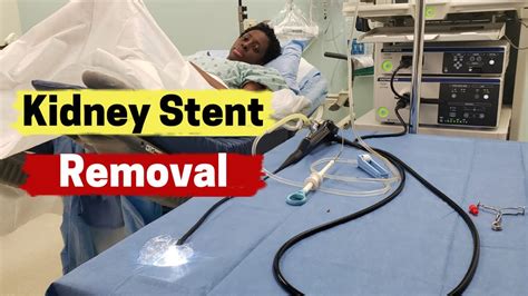 Kidney Stent Removal | What is Involved in Kidney Stent Removal - YouTube