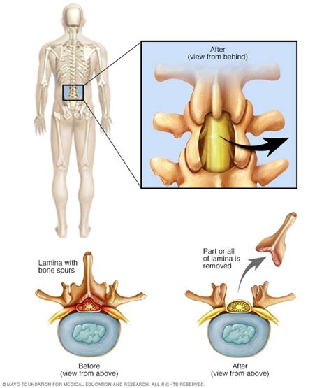 Laminectomy - Mayo Clinic