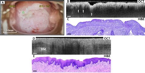 Typical images of HSIL cervical tissues. Colposcopy image (A), OCT... | Download Scientific Diagram