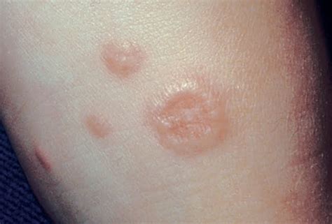 Get all the information about Granuloma Annulare; symptoms and causes