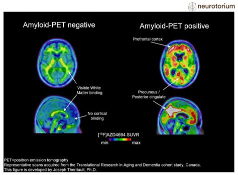 Amyloid-PET imaging in Alzheimer's disease - Neurotorium