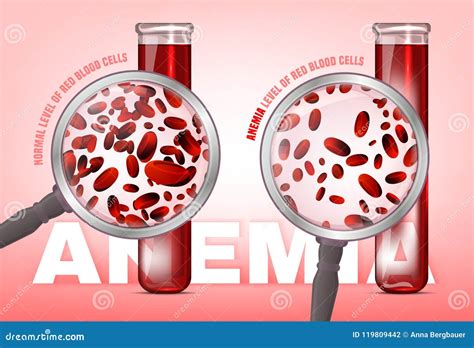 Anemia Level of Blood Cells Stock Vector - Illustration of anaemia ...