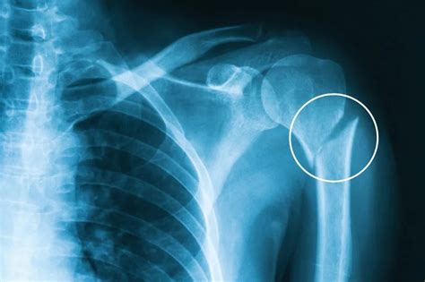 Humerus Fracture: Types, Symptoms & Treatment (2023)