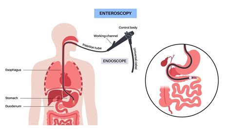 Premium Vector | Balloon assisted enteroscopy Visualization of the small intestine nonsurgical ...