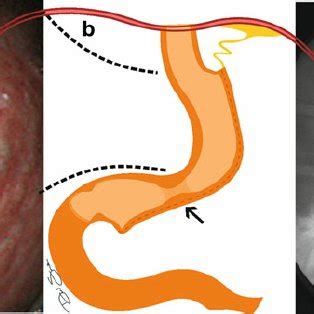 Images of angular incisure stenosis ( arrow ) and fistula after sleeve... | Download Scientific ...