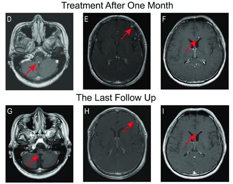 Changes of brain MRI before and after anti-tuberculosis treatment. The... | Download Scientific ...