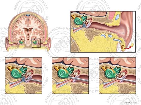 Surgical Repair of Left Perilymphatic Fistulas - No Text