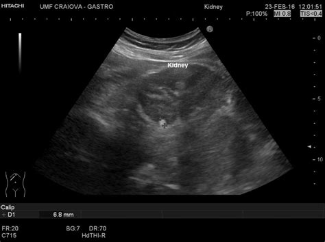 Renal stones [2 images] – EFSUMB