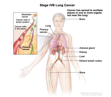 Non-Small Cell Lung Cancer Treatment (PDQ®) - NCI