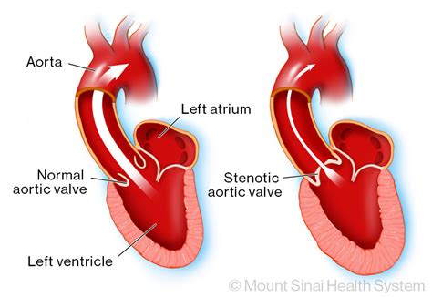 Aortic Stenosis Diagnosis & Treatments | Mount Sinai - New York