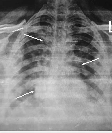 Chest X-ray showing infiltrates and pneumonic patches in both lungs. | Download Scientific Diagram