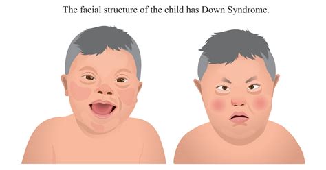 Down Syndrome: Symptoms, Causes, Prevention and Treatments