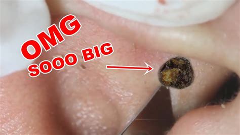 BIG EAR Blackheads Extraction - YouTube