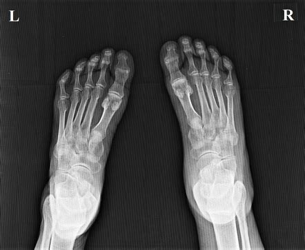 Ainhum | Radiology Reference Article | Radiopaedia.org