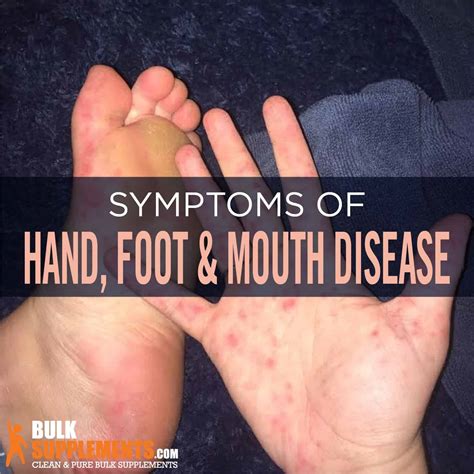 Hand, Foot, and Mouth Disease (HFMD): Symptoms, Causes & Treatment