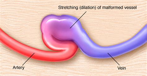 Arteriovenous Fistula - For Dialysis, Dural, Symptoms