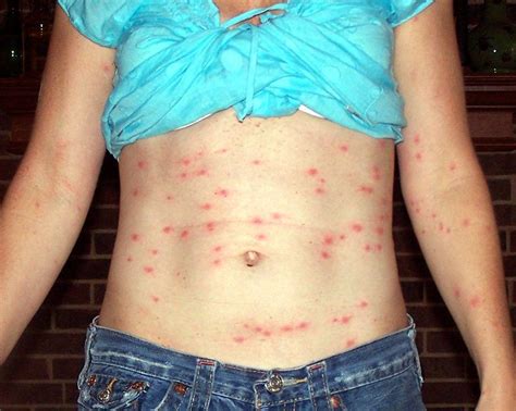 Chiggers (Mite) Bites, Rash Pictures, Treatment, Eradication | Healthhype.com