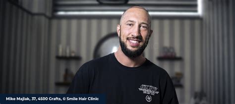 HeyBigMike Here for a Hair Transplant - Smile Hair Clinic