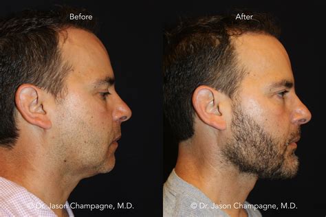 Custom Chin and Jaw Implants — Plastic Surgeon Beverly Hills, CA | Dr. Jason Champagne