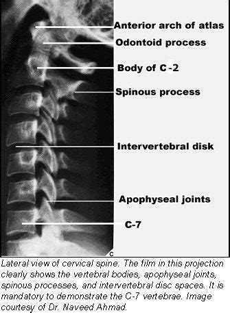 Radiographic positioning techniques for the cervical spine | AuntMinnie