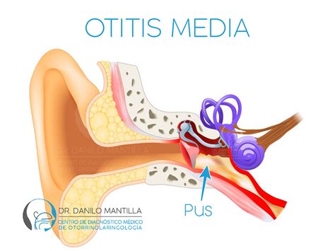 Dolor de oído | Dr. Danilo Mantilla ORL | Otalgia | Diagnóstico y tratamiento