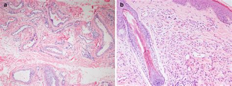 Histology of Vascular Malformations | Oncohema Key