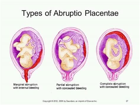 Placental Abruption - Symptoms, Complications & Treatment - Santripty