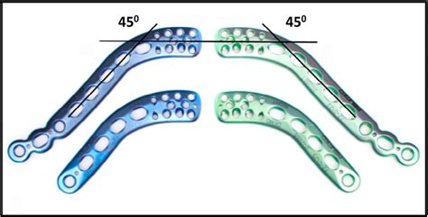 Acumed Lateral Clavicle (Hillsboro, OR, USA) short (13-hole) and long... | Download Scientific ...