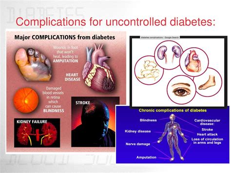 powerpoint presentation on diabetes mellitus