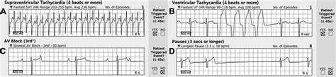 Sample Zio Patch reports. (A) SVT, (B) VT, (C) third-degree... | Download Scientific Diagram