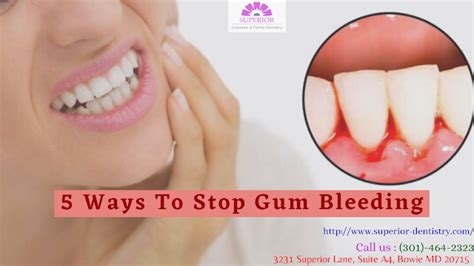 Five ways to stop bleeding gums (Treat your Gum Disease)