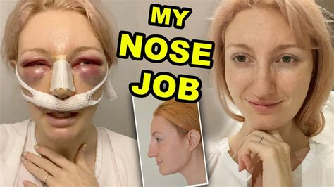 MY NOSE JOB | PART 1 | RHINOPLASTY & SEPTOPLASTY SURGERY & RECOVERY ...