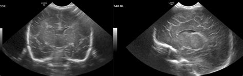 Cranial Ultrasound | UAMS Department of Radiology