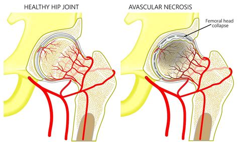 Avascular Necrosis Femoral Head: Symptoms & Treatment | Wockhardt Hospitals