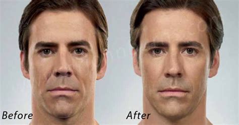 Juvederm and Facial Fillers for Men | Dr. John Burns – Dr John Burns