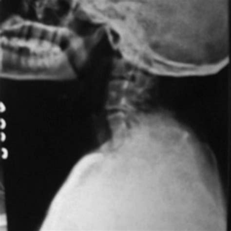 X-ray spine shows a fusion of C2–C3, C4–C5–C6 vertebrae. | Download Scientific Diagram