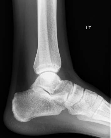 Ankle effusion - teardrop sign | Radiology Case | Radiopaedia.org