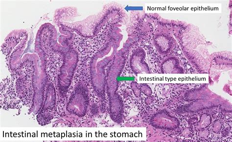 Intestinal metaplasia | MyPathologyReport.ca