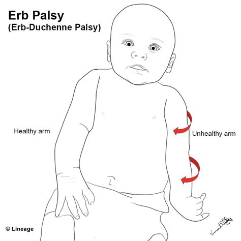 Erb-Duchenne Palsy - MSK - Medbullets Step 1