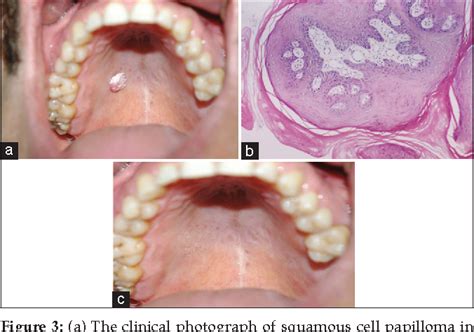 Figure 3 from Verrucous carcinoma and squamous cell papilloma of the oral cavity: Report of two ...